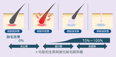 獲得永久脫毛，令人驚訝的(de)無痛和(hé)高(gāo)效，秘密是......